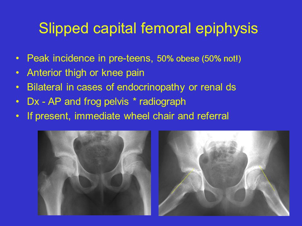 Slipped capital femoral epiphysis